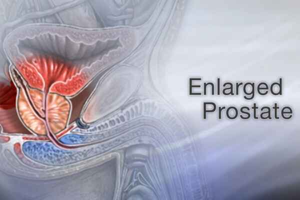 Finding Relief from an Enlarged Prostate with Dr. Kalyan Kumar A.V.