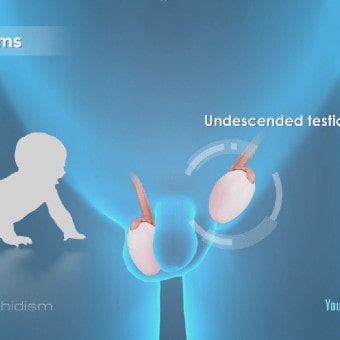 Undescended Testis