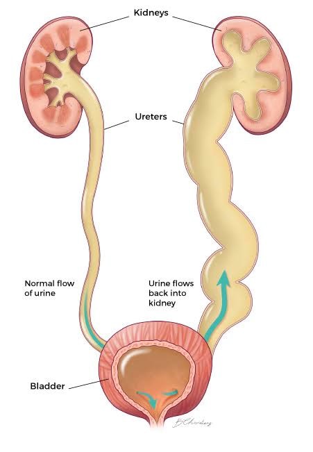 Understanding Pediatric Vesicoureteral Reflux